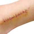 Caring for Healing Wounds: What Do Dissolvable Stitches Look Like and When to Seek Help