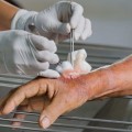 What To Expect From A Mechanical Wound Debridement Procedure With Your Wound Care Specialist