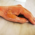 Wound Care Specialist Strategies For Managing First Degree Chemical Burn Stages