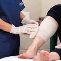 How Wound Care Experts Select The Best Dressing For Stage 2 Pressure Ulcers