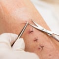 How Long Does It Take for Stitches to Dissolve? Specialist Recommendations for a Smooth Recovery