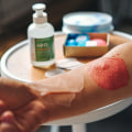 Step-by-Step Guide to 2nd Degree Burn Blister Healing Stages by a Wound Care Specialist