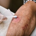 The Importance of Proper Wound Care: Understanding the Complex Healing Process