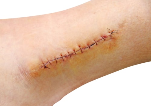 Caring for Healing Wounds: What Do Dissolvable Stitches Look Like and When to Seek Help