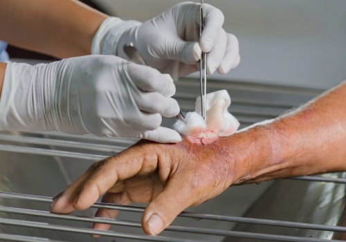 What To Expect From A Mechanical Wound Debridement Procedure With Your Wound Care Specialist