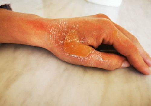 Wound Care Specialist Strategies For Managing First Degree Chemical Burn Stages