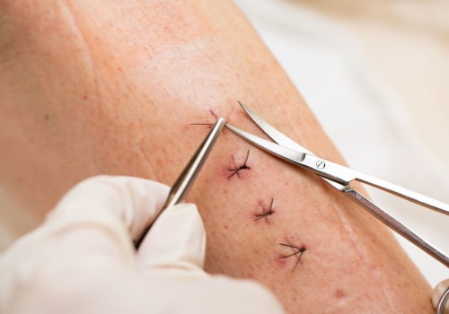 How Long Does It Take for Stitches to Dissolve? Specialist Recommendations for a Smooth Recovery