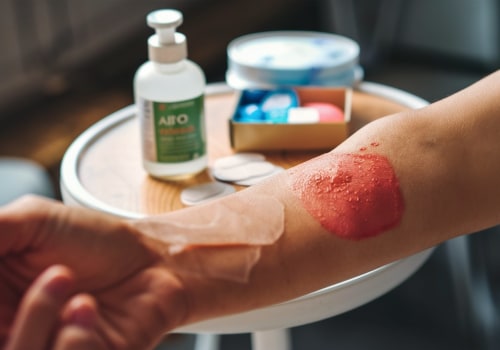 Step-by-Step Guide to 2nd Degree Burn Blister Healing Stages by a Wound Care Specialist