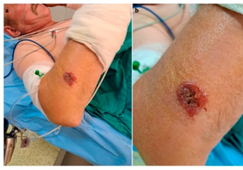 Why A Wound Specialist Is Essential For Treating A Denuded Wound